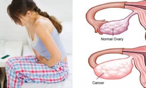 Ce-este-si-ce-simptome-are-cancerul-ovarian?